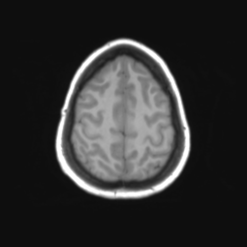 File:Cerebellar ependymoma complicated by post-operative subdural hematoma (Radiopaedia 83322-97736 Axial T1 33).png