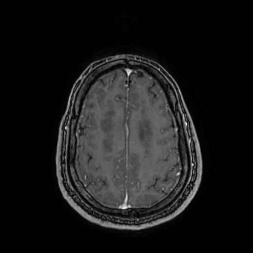 Cerebellar hemangioblastoma (Radiopaedia 88055-104622 Axial T1 C+ 136).jpg