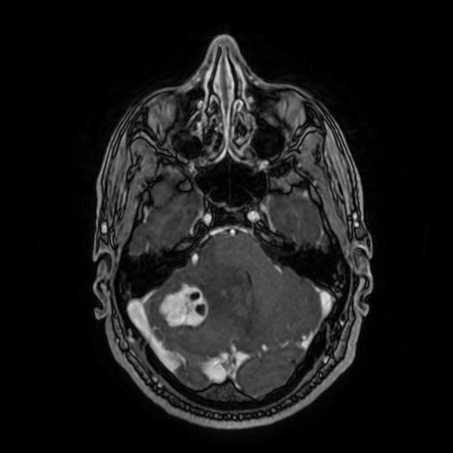 Cerebellar hemangioblastoma (Radiopaedia 88055-104622 Axial T1 C+ 60).jpg