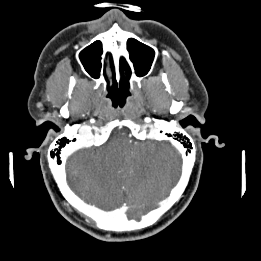 Cerebellar infarct due to vertebral artery dissection with posterior fossa decompression (Radiopaedia 82779-97029 C 31).png