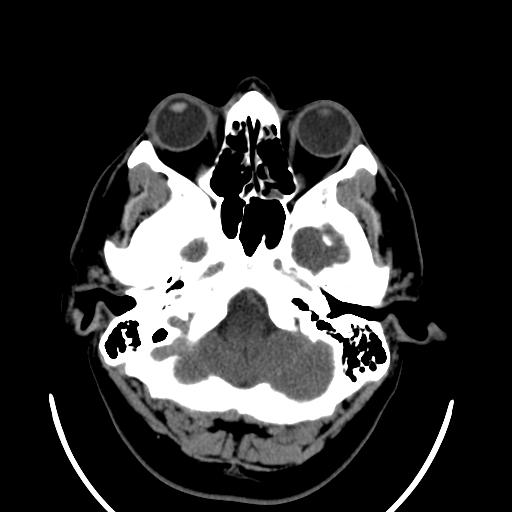 File:Cerebellar infarction (Radiopaedia 16625-16327 Axial non-contrast 8).jpg