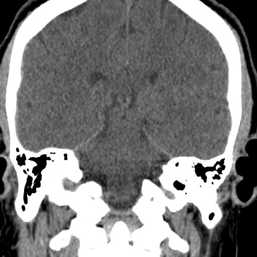 Cerebellar infarction (Radiopaedia 16625-16327 Coronal non-contrast 17).jpg