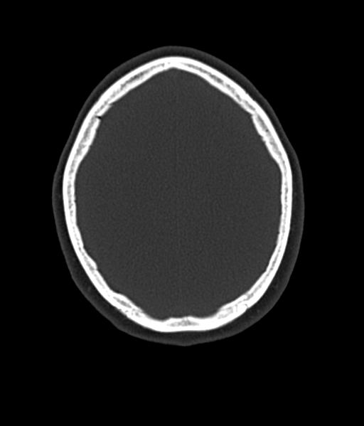 File:Cerebellar metastases - colorectal adenocarcinoma (Radiopaedia 40947-43652 AX Bone C- 2.0 MPR 50).png