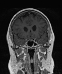 File:Cerebellar metastasis (Radiopaedia 54578-60810 Coronal T1 C+ 13).png