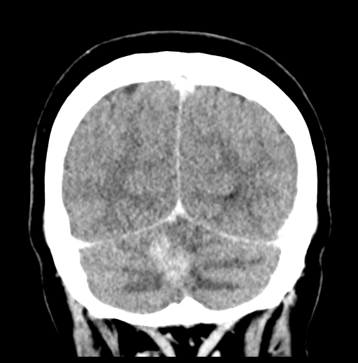 Cerebellar metastasis (Radiopaedia 54578-60812 Coronal C+ 50).png