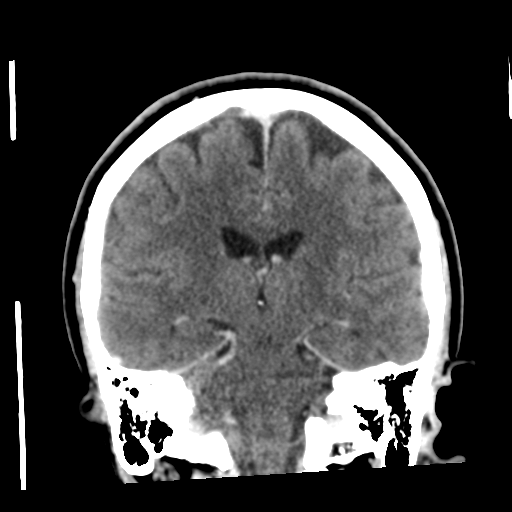 Cerebellar metastasis (cystic appearance) (Radiopaedia 41395-44258 D 37).png