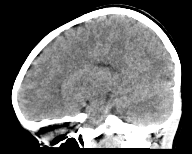 File:Cerebellar stroke (Radiopaedia 32202-33149 B 12).png