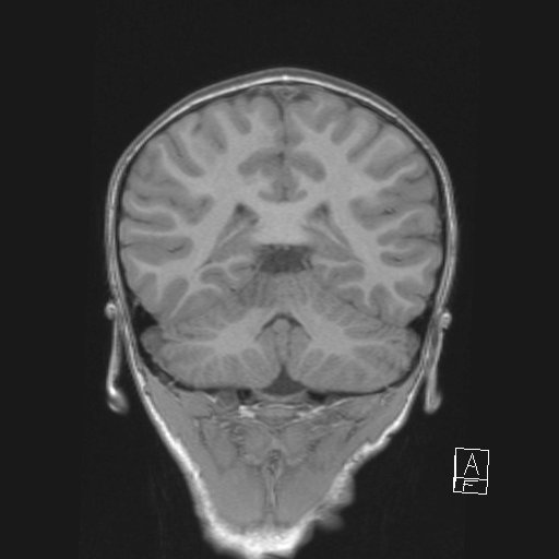 File:Cerebellar stroke (Radiopaedia 32202-33150 Coronal T1 40).png