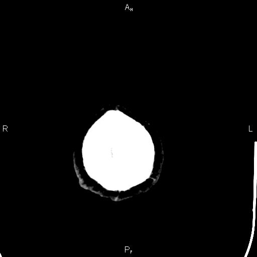 File:Cerebellopontine angle arachnoid cyst (Radiopaedia 85149-100704 Axial With contrast 54).jpg