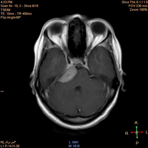 File:Cerebellopontine angle meningioma (Radiopaedia 22488-22525 Axial T1 C+ 5).jpg