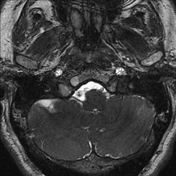 Cerebellopontine angle meningioma (Radiopaedia 24459-24764 I 10).jpg