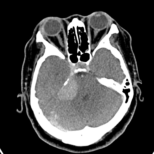 Cerebellopontine angle meningioma (Radiopaedia 35181-36714 A 18).jpg
