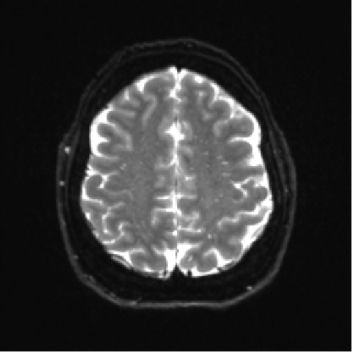 Cerebellopontine angle meningioma (Radiopaedia 48434-53348 Axial DWI 30).png