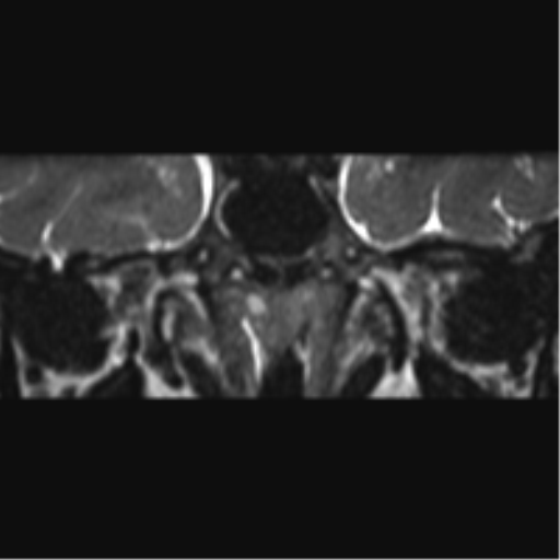 Cerebellopontine angle meningioma (Radiopaedia 48434-53348 Coronal T2 78).png