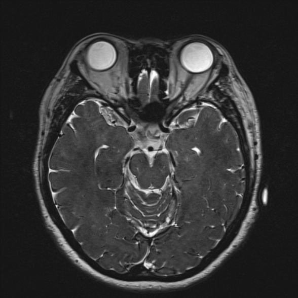 Cerebellopontine angle meningioma (Radiopaedia 53561-59591 Axial 3D volume T2 94).jpg