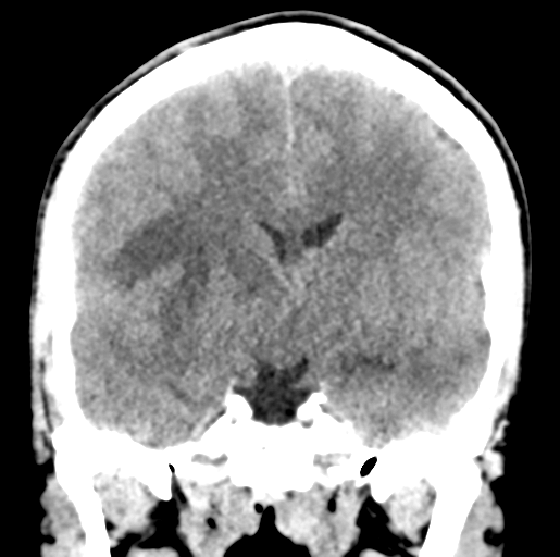 Cerebral abscess (Radiopaedia 60342-68008 Coronal non-contrast 31).png