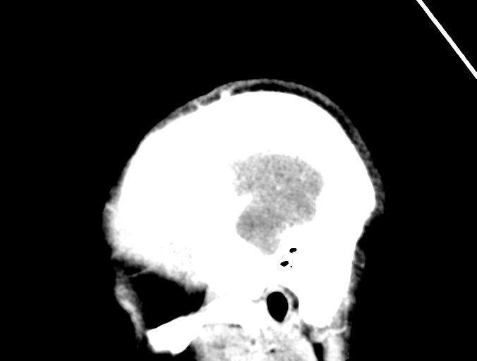 Cerebral abscess (Radiopaedia 60342-68008 Sagittal C+ delayed 46).png