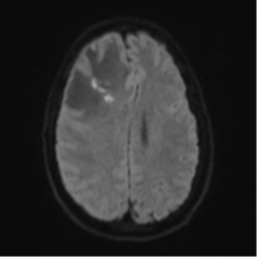 Cerebral abscess (Radiopaedia 60342-68009 Axial DWI 60).png