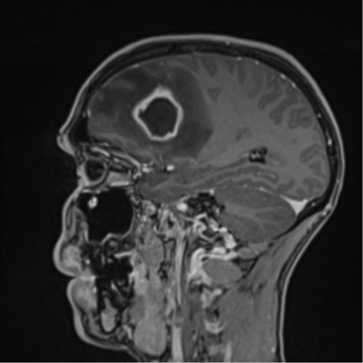 File:Cerebral abscess (Radiopaedia 60342-68009 J 38).png