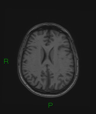 Cerebral abscess and subdural empyema (Radiopaedia 84436-99779 Axial T1 34).jpg