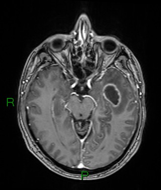 Cerebral abscess and subdural empyema (Radiopaedia 84436-99779 Axial T1 C+ 52).jpg