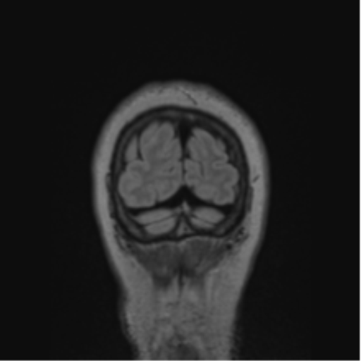Cerebral abscess from pulmonary arteriovenous malformation (Radiopaedia 86275-102291 Coronal FLAIR 12).png