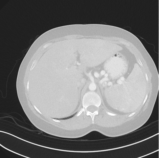 File:Cerebral abscess from pulmonary arteriovenous malformation (Radiopaedia 86275-102292 Axial lung window 59).png
