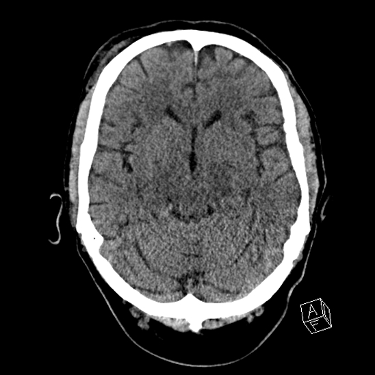 Cerebral abscess with ventriculitis (Radiopaedia 78965-91876 Axial non-contrast 21).jpg