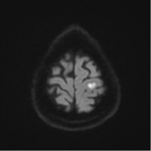 Cerebral abscesses- medically managed (Radiopaedia 45183-49179 Axial DWI 53).png