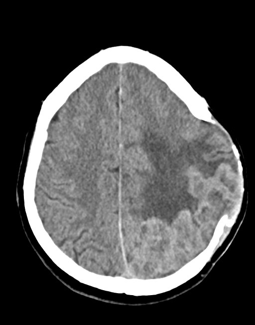 Cerebral abscesses (Radiopaedia 70458-80568 Axial non-contrast 45).jpg