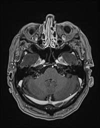 Cerebral amyloid angiopathy-related inflammation (Radiopaedia 58270-65377 Axial T1 C+ fat sat 27).jpg