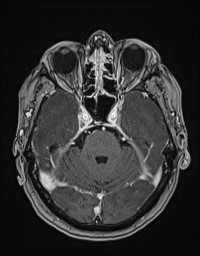 Cerebral amyloid angiopathy-related inflammation (Radiopaedia 58270-65377 Axial T1 C+ fat sat 39).jpg