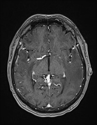 Cerebral amyloid angiopathy-related inflammation (Radiopaedia 58270-65377 Axial T1 C+ fat sat 65).jpg