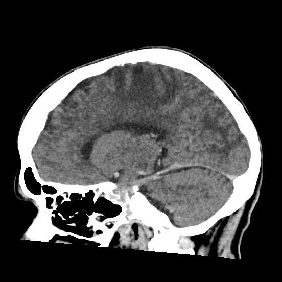 Cerebral amyloid angiopathy-related inflammation (Radiopaedia 74836-85848 C 25).jpg
