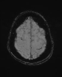 File:Cerebral amyloid angiopathy-related inflammation (Radiopaedia 74836-85849 Axial SWI 60).jpg