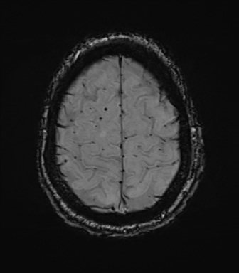 Cerebral amyloid angiopathy (Radiopaedia 46082-50433 Axial SWI 72).png