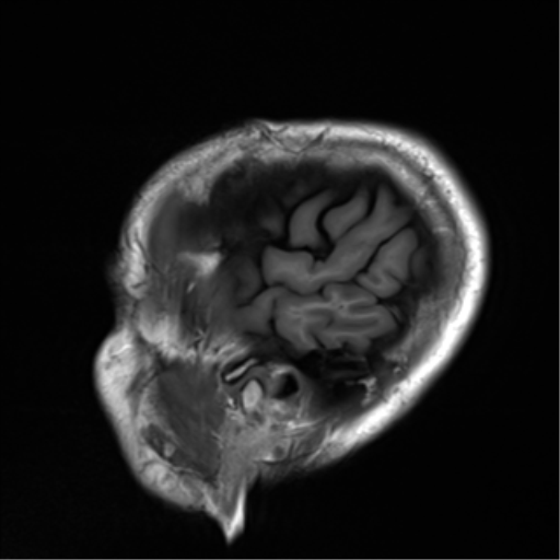 File:Cerebral amyloid angiopathy (Radiopaedia 46082-50433 Sagittal T1 26).png