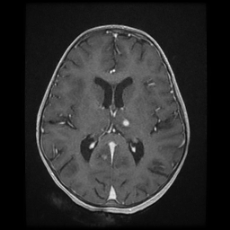 Cerebral and spinal tuberculosis (Radiopaedia 90489-107837 Axial T1 C+ 113).jpg
