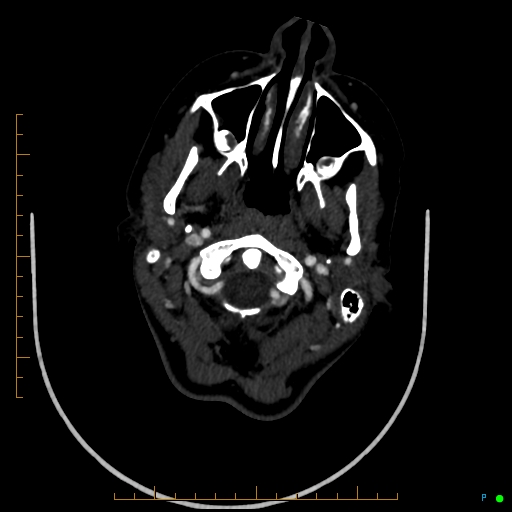Cerebral arteriovenous malformation (AVM) (Radiopaedia 78162-90706 Axial CTA 38).jpg