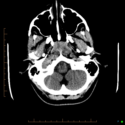 Cerebral arteriovenous malformation (AVM) (Radiopaedia 78162-90706 Axial non-contrast 11).jpg