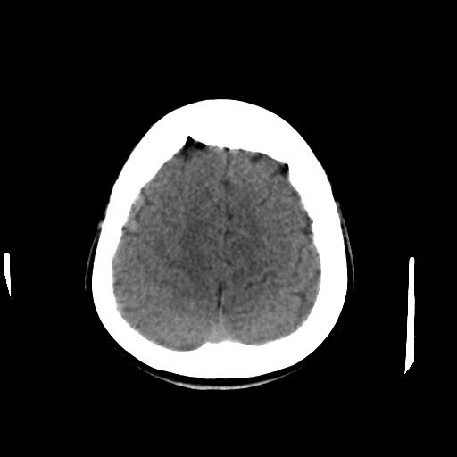 Cerebral arteriovenous malformation (Radiopaedia 28518-28759 Axial non-contrast 60).jpg