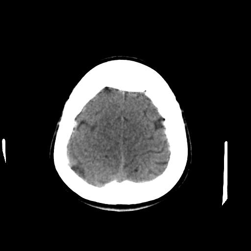 Cerebral arteriovenous malformation (Radiopaedia 28518-28759 Axial non-contrast 63).jpg