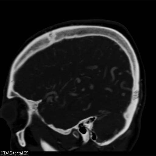 File:Cerebral arteriovenous malformation (Radiopaedia 28518-28759 D 56).jpg