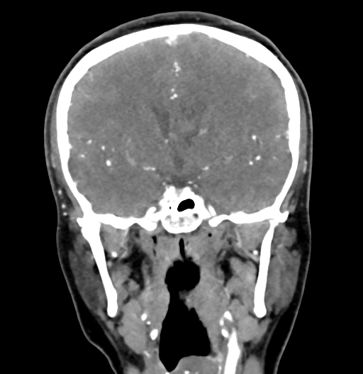 Cerebral arteriovenous malformation (Radiopaedia 73830-84645 C 47).jpg