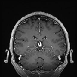Cerebral arteriovenous malformation (Radiopaedia 84015-99245 Coronal T1 C+ 104).jpg