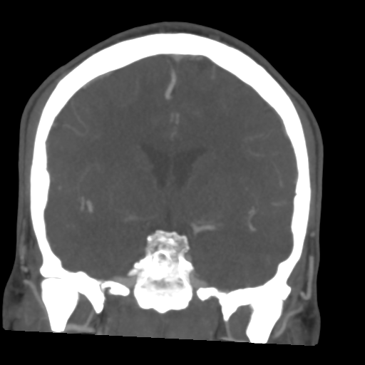 Cerebral arteriovenous malformation (Spetzler-Martin grade 2) (Radiopaedia 41262-44076 F 29).png