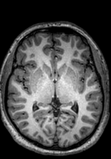 Cerebral arteriovenous malformation at posterior body of corpus callosum (Radiopaedia 74111-84925 Axial T1 150).jpg