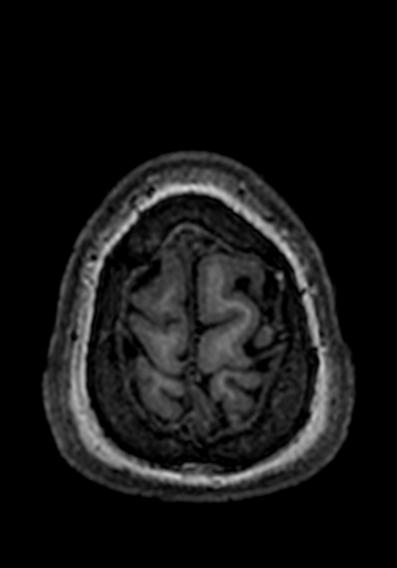 File:Cerebral arteriovenous malformation at posterior body of corpus callosum (Radiopaedia 74111-84925 Axial T1 8).jpg