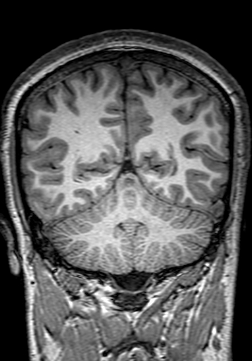 Cerebral arteriovenous malformation at posterior body of corpus callosum (Radiopaedia 74111-84925 Coronal T1 250).jpg