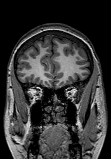 File:Cerebral arteriovenous malformation at posterior body of corpus callosum (Radiopaedia 74111-84925 Coronal T1 54).jpg